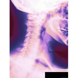 Colorized X Ray Showing Normal Cervical Spine Lateral View Vertebrae 