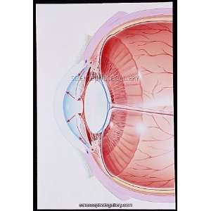  Artwork showing glaucoma, eye in cross section 